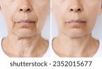 Small photo of Lower part of face and neck of a caucasian elderly woman with signs of skin aging before after facelift, plastic surgery. Age-related changes, flabby saggy skin, wrinkles, creases. Rejuvenation