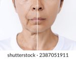 Small photo of Lower part of face and neck of elderly woman with signs of skin aging before after plastic surgery. Age-related changes, flabby sagging skin, wrinkles, creases, puffiness. Rejuvenation, facelift