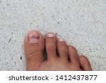 The feet that had the nails swelled from the wounded nails were placed on the cement floor, placed outdoors and placed the image in the middle.Nail injury
