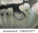 Periapical x ray film of dental ...
