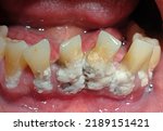 Small photo of Very heavy Tartar in teeth or Dental calculus dental calculus at lower anterior tooth with periodontitis or periodontal disease