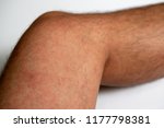 Small photo of Close up of Measles rash on patient's leg skin, Symptoms of German Measles or Rubella infection