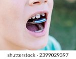 Small photo of Boy getting an orthodontic appliance to correct jaw misalignment.