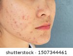 Small photo of Close-up of woman half face with problems of acne inflammation (Papule and Pustule) on her face. Conceptual of problems on woman skin.