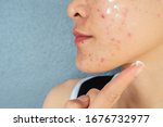 Small photo of Cropped shot of woman half face with acne inflammation (Papule and Pustule) on her face and she applying acne cream on her face for treat. Conceptual of problems on woman skin.