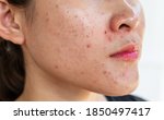 Small photo of Cropped shot of woman having problems of acne inflamed on her face. Inflamed acne consists of swelling, redness, and pores that are deeply clogged with bacteria, oil, and dead skin cells.