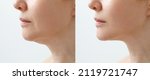 Small photo of A close portrait of an aged woman before and after facial rejuvenation procedure. Correction of the chin shape liposuction of the neck. The result of the procedure in the clinic of aesthetic medicine.
