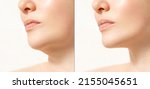 Small photo of Female double chin before and after correction. Correction of the chin shape liposuction of the neck. The result of the procedure in the clinic of aesthetic medicine.