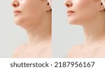 Small photo of Female double chin before and after correction. Correction of the chin shape liposuction of the neck. The result of the procedure in the clinic of aesthetic medicine.