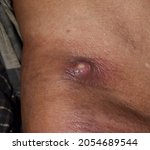 Small photo of Large carbuncle or abscess at trunk of Asian Burmese male patient.