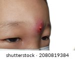 Small photo of Carbuncle or abscess at forehead of Asian child.