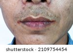 Small photo of Angular stomatitis or angular cheilitis or perleche in asian alcoholic man. Common inflammatory condition of angles of mouth. Cracked lips.