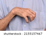 Small photo of Volkmann’s contracture in left upper limb of Southeast Asian elder man. It is a permanent shortening of forearm muscles that gives rise to a clawlike posture of the hand, fingers, and wrist.
