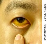 Small photo of Deep jaundice of eye in Asian male patient. Yellowish discoloration of skin and sclera. Hyperbilirubinemia. Acute hepatitis.