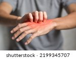 Small photo of Asian young man scratching his hand. Concept of itchy skin diseases such as scabies, fungal infection, eczema, psoriasis, rash, allergy, etc.