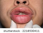 Small photo of Swollen or thickened lips of Asian young man. Angioedema. Filler injection complications. Causes may be allergies, infection, injury, etc.