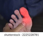 Small photo of Inflammation in the big toe of Asian man. Concept of foot joint pain, arthritis, stumble, hyperuricema or gout.