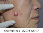 Small photo of Carbuncle or nodular acne in face of Asian Burmese male patient.