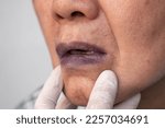 Small photo of Bluish discoloration of lips. Central cyanosis in Asian old man with congenital heart disease.