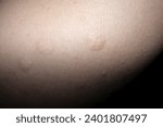 Small photo of atopic skin. Dermatitis, diathesis, allergy on the child's body irritation