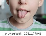 Small photo of White spots on the kid tongue. Oral thrush is a fungal infection that affects the soft tissue inside the mouth. It is quite common in young children.