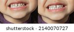 Small photo of The child shows milk teeth with stains and plaque close-up. Two photos before and after. Children's dentistry. Health and dental care, caries treatment, baby teeth. Dark spots on teeth