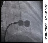 Small photo of technique of percutaneous Transvenous mitral commissurotomy using the Inoue balloon catheter