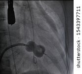 Small photo of x ray image perform balloon catheter inflation in Percutaneous transvenous mitral commissurotomy (ptmc) procedure