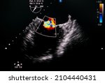 Small photo of Echocardiography image show mitral valve stenosis