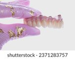 Zirconium Arch with Screw Retained Implants and Artificial Gum