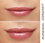Small photo of Women lips correction before and after comparison. Hyaluronic acid injection. Beauty lip treatment procedure.