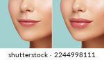 Small photo of Comparison of Women lips correction before and after Hyaluronic acid injection. Injected and non-injected lips. Beauty lip treatment procedure. Natural lips shape. Lips Augmentation