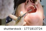 Small photo of Dentist making local anaesthesia shot before surgery. Senior woman at dental clinic. Dentist with assistant install implant in a patient mouth in modern dental office