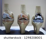 Model Of Knee Joint Showing...