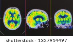Small photo of an array of positron emission tomography or PET images showing many phase of brain perfusion function and activity