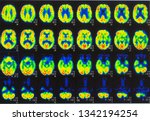 Small photo of an array of positron emission tomography or PET images showing many phases of brain perfusion function and activity