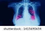 Small photo of Chest x-ray of a patient showing primary lung cancer in both right and left lobe of lung. Dark background with red highlight focus on the tumor.