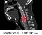 Small photo of Computer tomography or CT scan of cervical spine showing ossified posterior longitudinal ligament or OPLL at C5 and C6 level. The pathology causes myelopathy and neck pain.