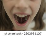 Small photo of Girl shows her SILVER CROWN (caps). Open mouth close up. Children's dental crowns. stainless steel crowns. Molars Root canal and crowning