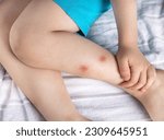 Small photo of kid child boy legs with mosquito bite big red spots.baby hand scratching the skin.father use spray anti mosquitos bites and capua.summertime consequences of walking in park.pain and inflammation