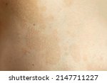 Small photo of Tinea versicolor (pityriasis versicolor), a fungal or yeast skin rash caused by too much growth of yeast, causing discoloration and patches. Skin problem, dermatology concept