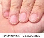 Small photo of Hand of a 9 year old boy showing his brittle fingernails, nail disease, extreme close up