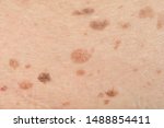 Dark spots and skin problems and itching Skin disease  freckles on the skin