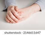 Small photo of Male hands with red spots on skin. Seasonal allergy, diathesis from allergic food, consequences of taking antibiotics. Arms in grey sleeves
