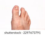 Small photo of micose Nail fungus infection on big toe. Fungal infection on fingernails toe with ringworm onychomycosis, disease result