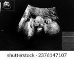Small photo of Echo photo of a fetus at 32 weeks pregnant