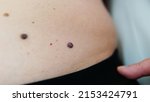 Small photo of Red moles and dots on the female body. Large mole on stomach. Melanoma, hemangiomas, lipoma, atheroma, malignant and benign moles. Oncology. The medicine. Close-up photo, blurry.