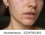 Small photo of the problem of acne pimples on the chin. facial skin care. combination skin