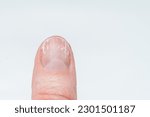 Small photo of A woman's finger with bitten and broken nails without manicure with an overgrown cuticle and a damaged nail plate after applying gel polish. Cosmetic procedures. Nail and hand care.