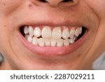 Small photo of Close-up of a smiling woman's teeth revealing white spots and plaque on the tooth surface. Oral care and Dental concept.